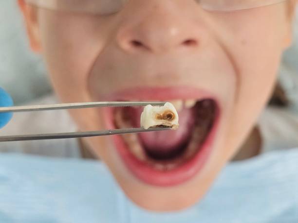 Best Emergency Root Canal Treatment in Dubuque, IA